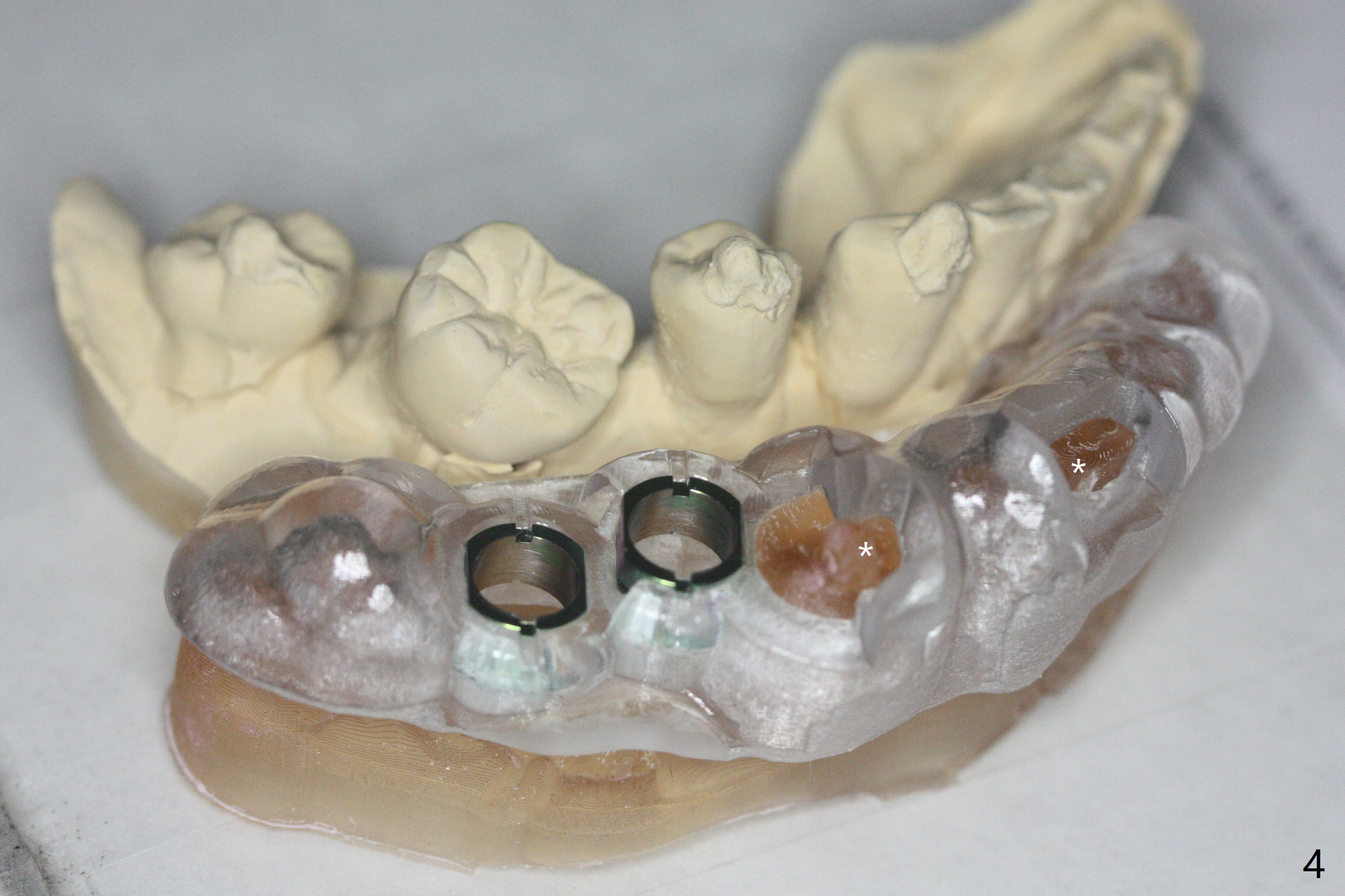 Composite Marker for Guided Immediate and Delayed Implants When the
